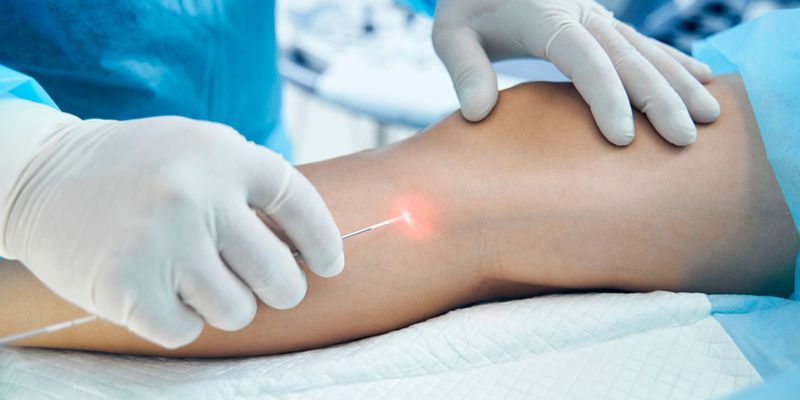 Procedimiento de endolaser o láser endovenoso para varices